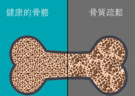 MQD-7000（骨密度仪）生产厂家国康主张骨折术后对抗“骨松”